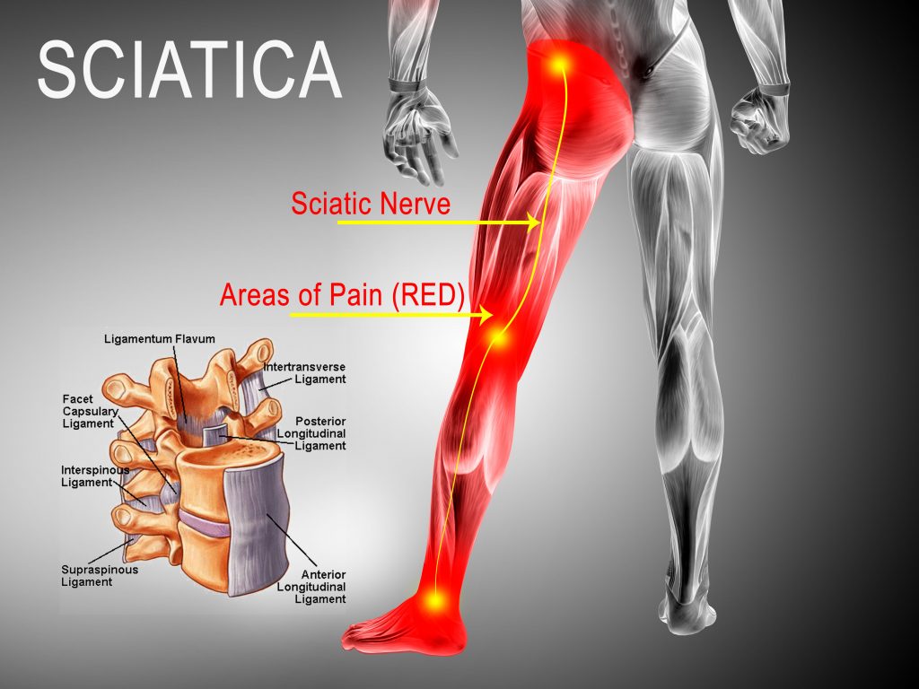 Deep Penetration & Long-Lasting Relief Natural Herbal Sciatic Nerve Orthopedic Plaster