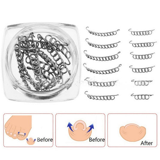 Ingrown Toe Nail Correction Wire (12pcs)