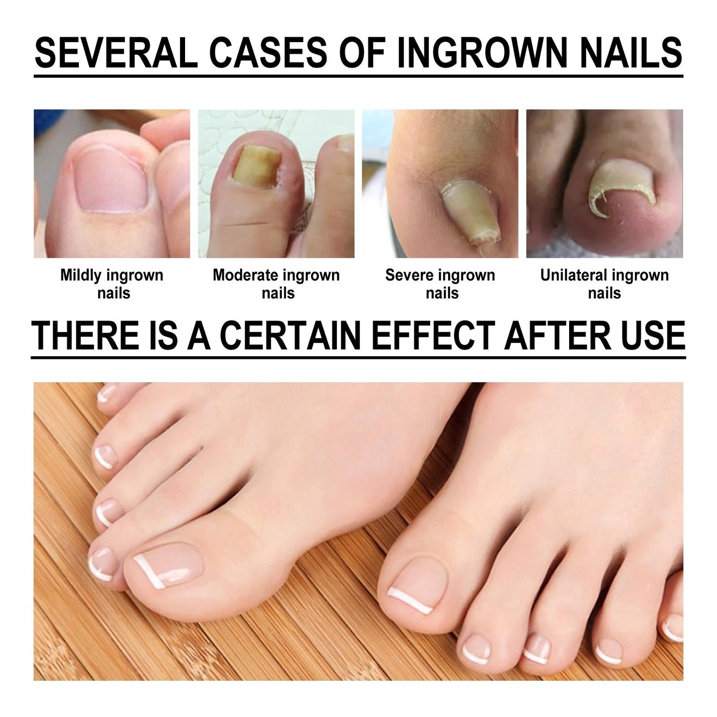Ingrown Toenail Treatment Softener Serum
