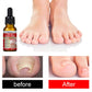 Ingrown Toenail Treatment Softener Serum