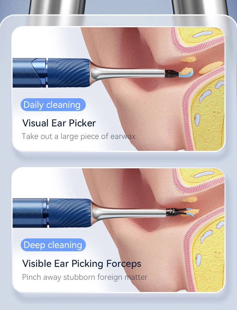WiFi 3-in-1 Ear Otoscope- HD Camera 360° Precision Robotic Tweezer & Gentle Silicone Earpick