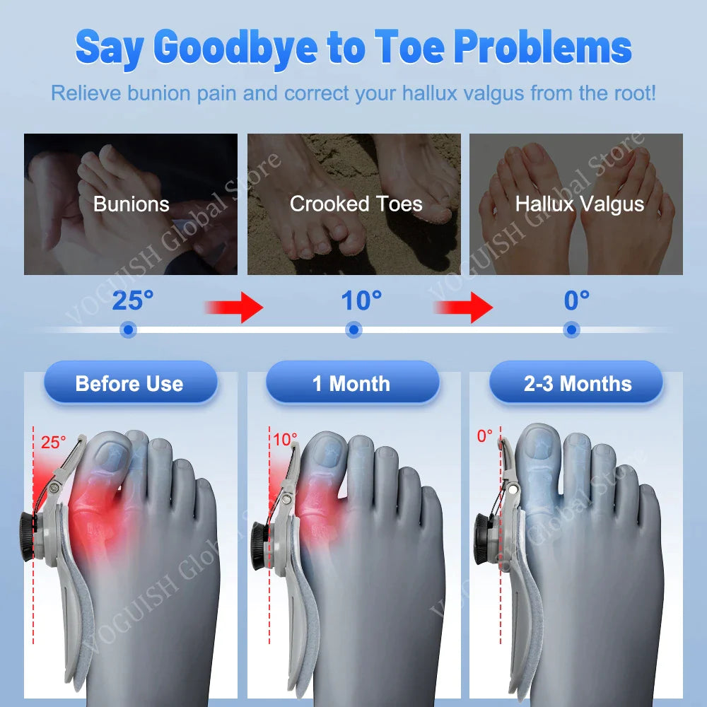AngleFlex - 180° Rotation Orthopedic Bunion Splint  Corrector