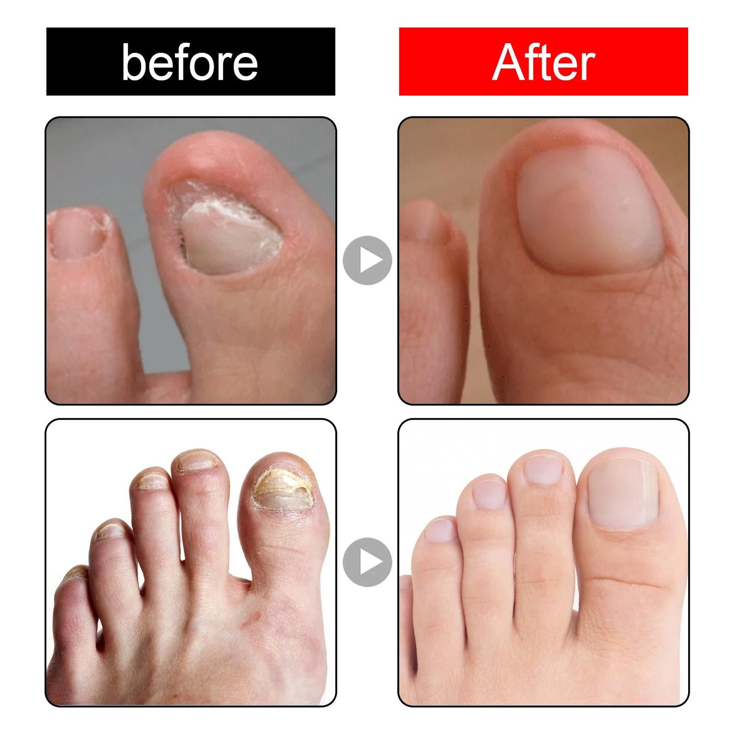 Ingrown Toenail Treatment Softener Serum