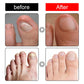 Ingrown Toenail Treatment Softener Serum