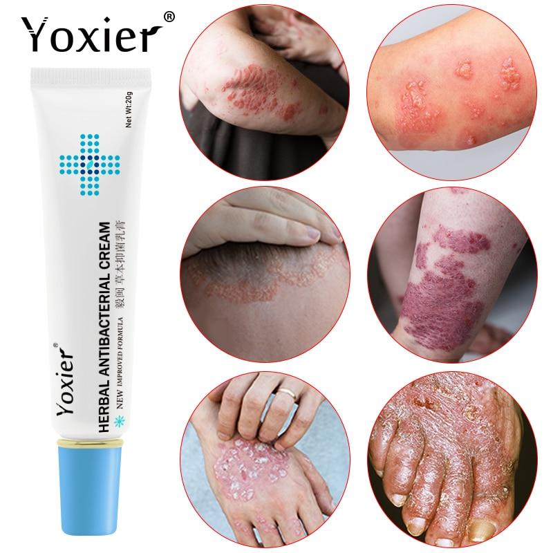 All-Natural Asian Herbal Eczema Treatment Cream