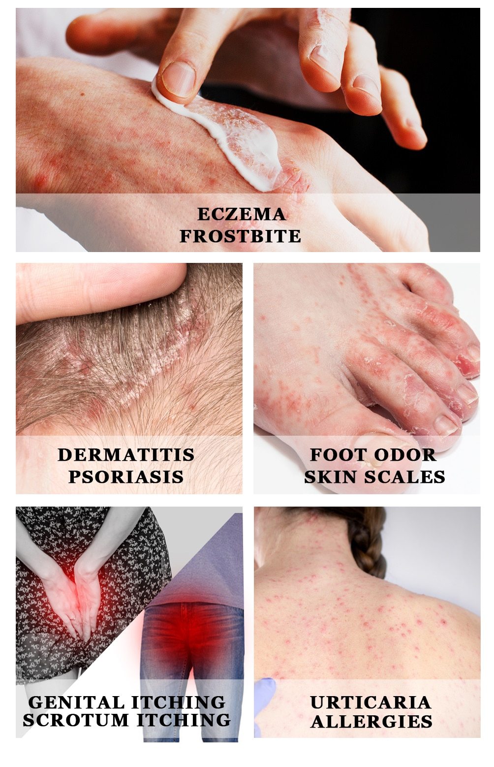 All-Natural Asian Herbal Eczema Treatment Cream
