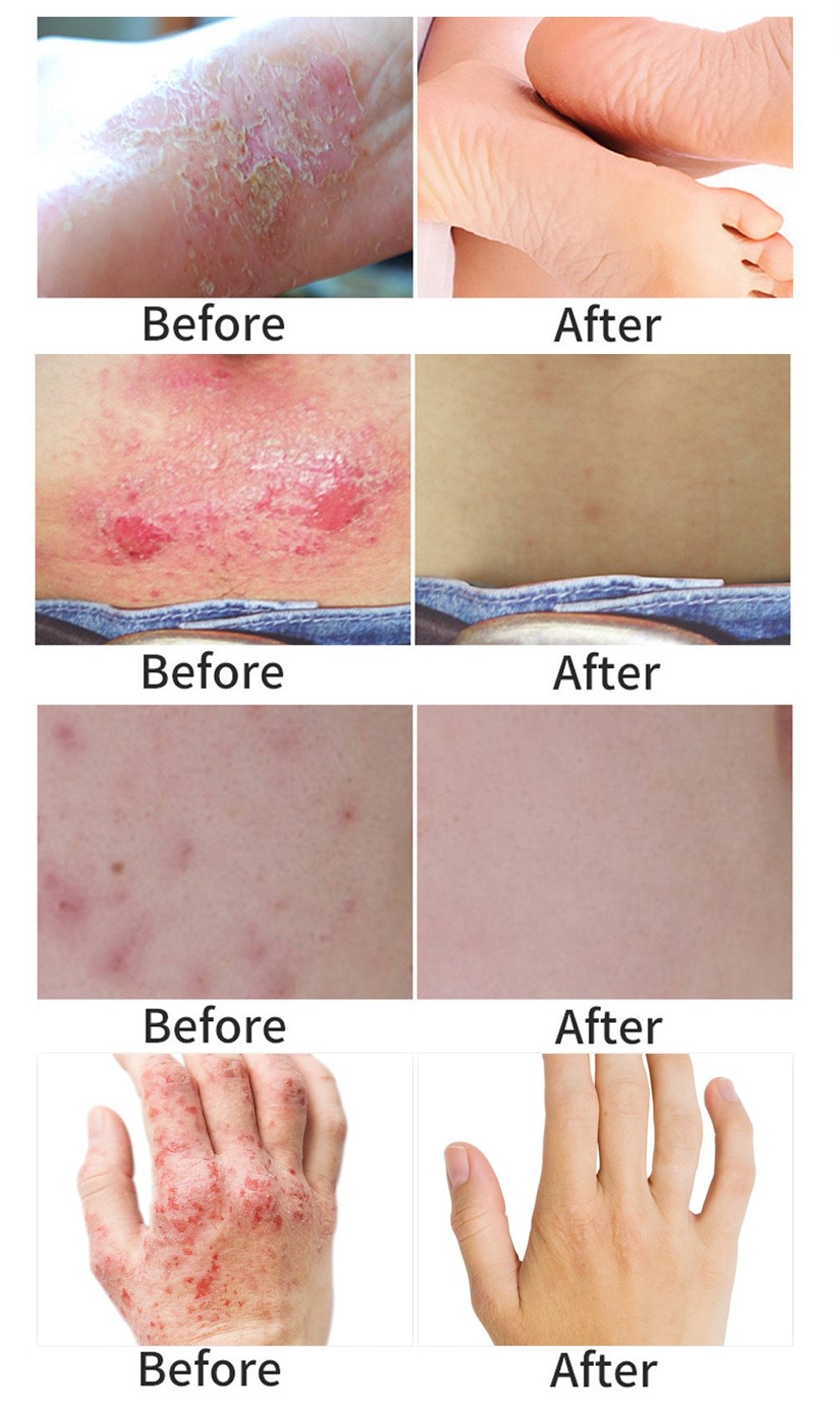 All-Natural Asian Herbal Eczema Treatment Cream