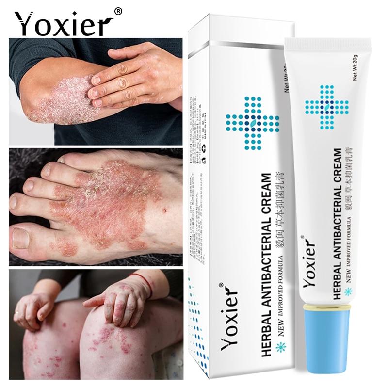 All-Natural Asian Herbal Eczema Treatment Cream
